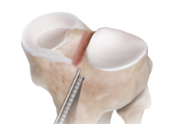 Dovetail-Slot Meniscal Implant